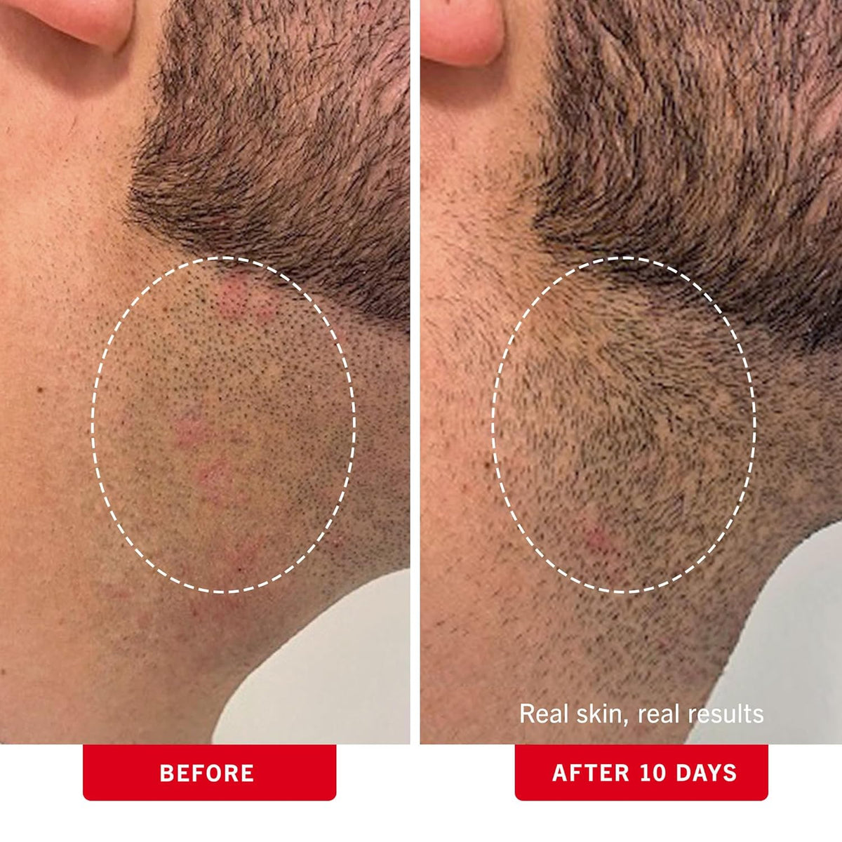 First Aid Beauty - Ingrown Hair Pads with BHA + AHA - Aftershave Treatment Pads to Help Prevent Razor Bumps for Men & Women - Exfoliate Underarms & Bikini Area - Compostable for Daily Use - 28 Pads